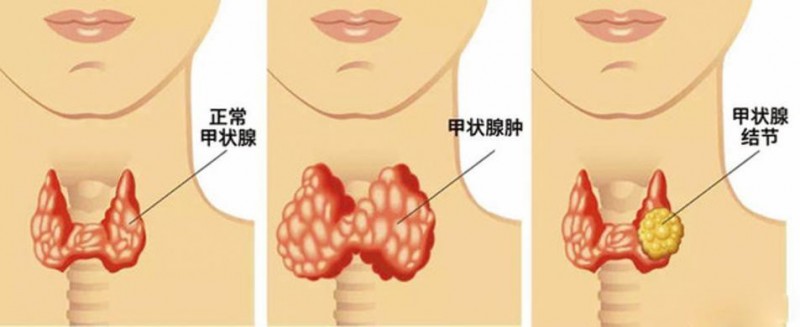 辅心堂中医：体检发现甲状腺结节，饮食上注意些什么？